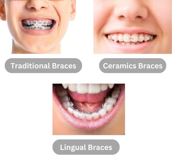 Type of Braces For Kids