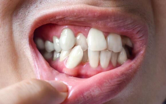 Tooth Extraction for Orthodontic Treatment 
