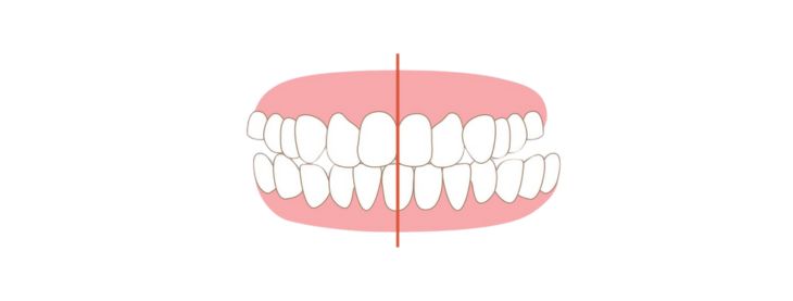 cross bite
