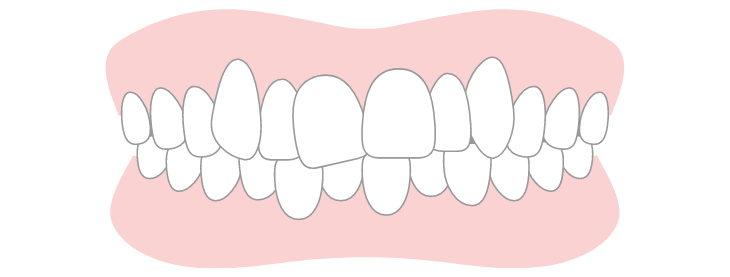 crowded teeth