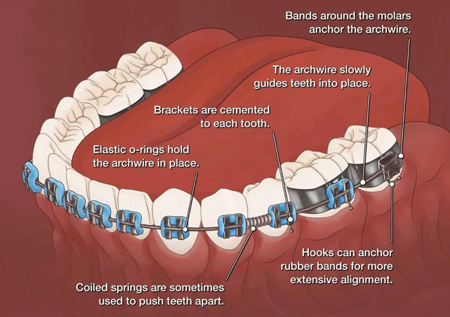 how brace works