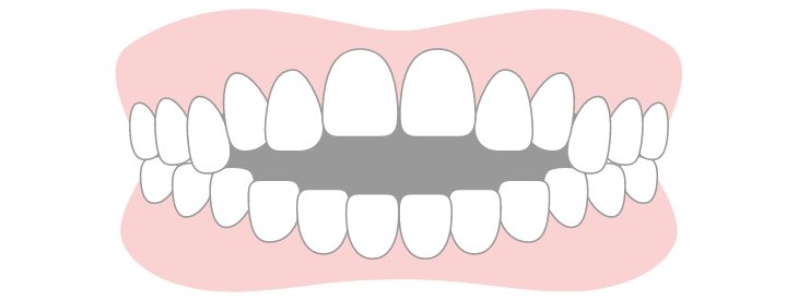 open bite