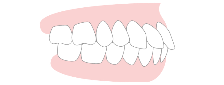 protrusion