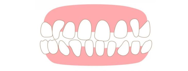 space between teeth