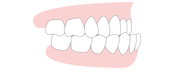 under bite